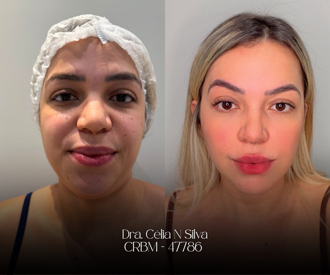 Antes e depois de endolaser facial