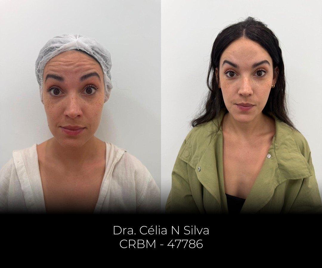 Antes e depois de full face, de frente