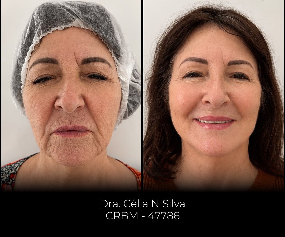 Antes e depois de harmonização full face