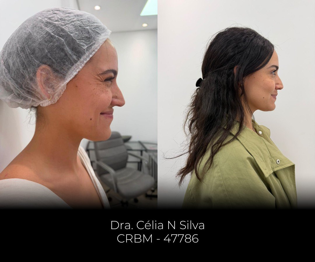 Antes e depois de full face, de perfil