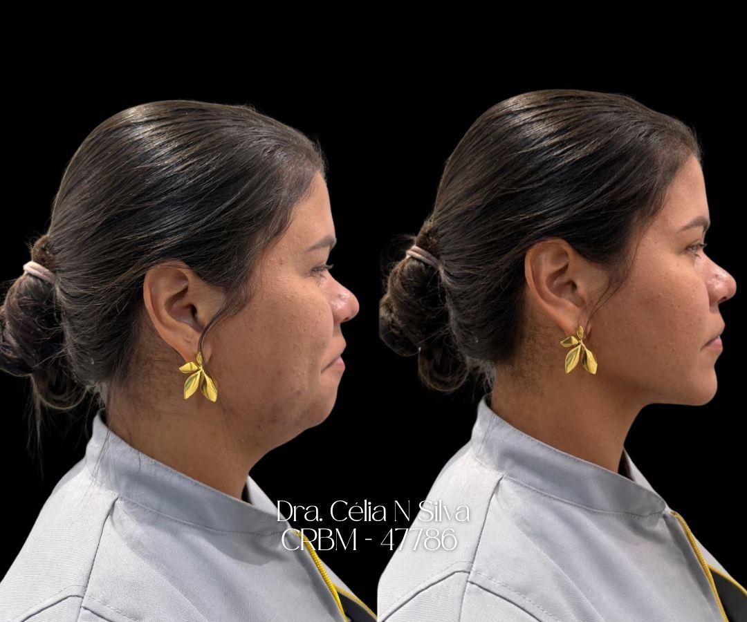 Antes e depois de tratamento de papada