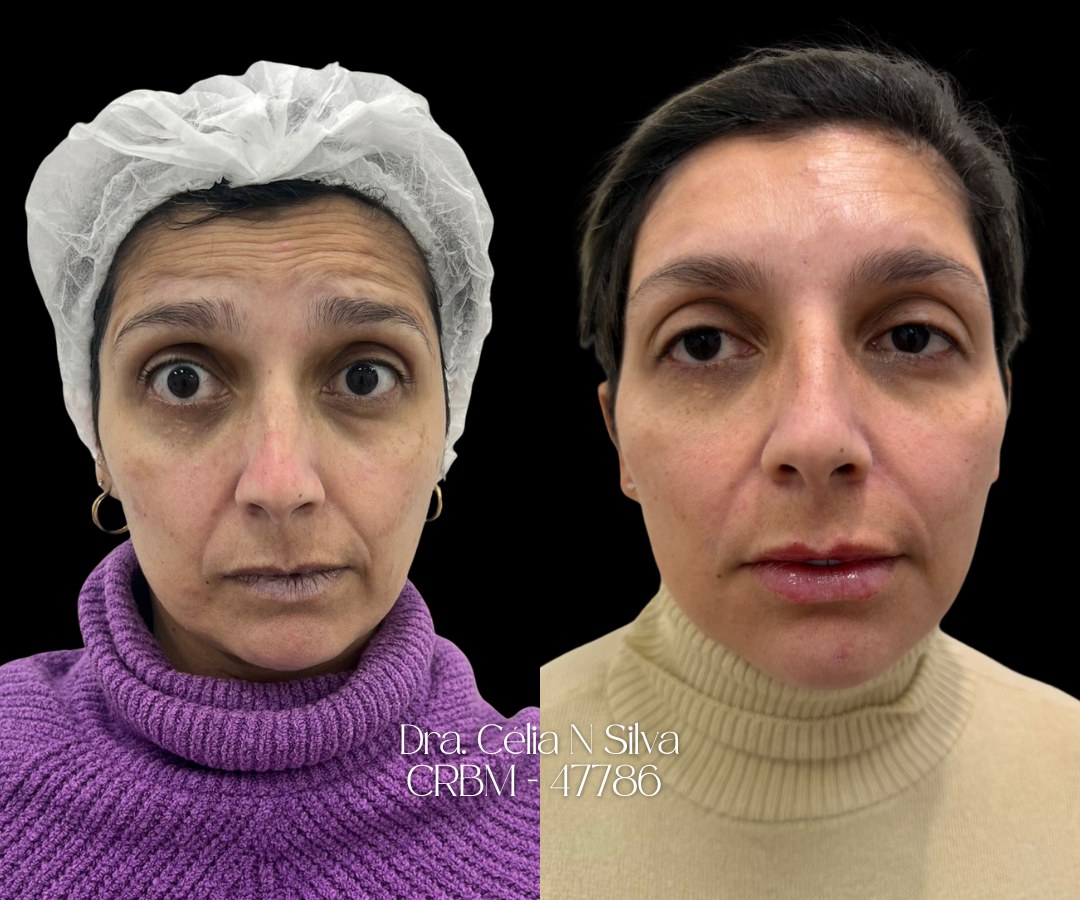 Antes e depois de tratamento facial
