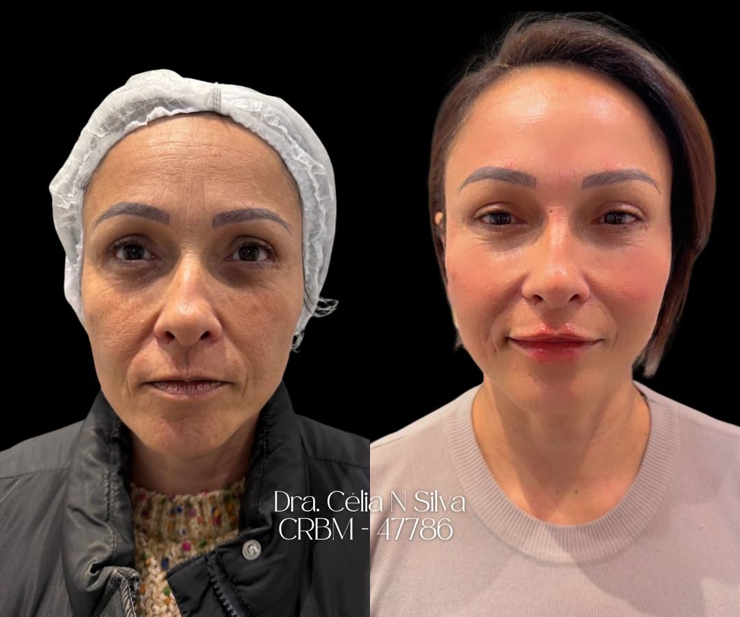 Antes e depois de rejuvenescimento facial