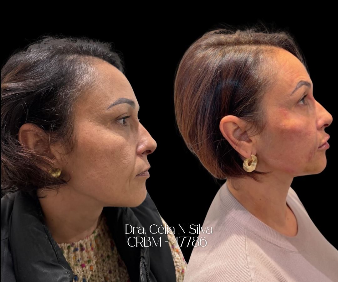 Antes e depois de tratamento facial